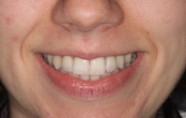 Smile Gallery - Church Road Dental and Cosmetic
