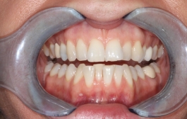 Smile Gallery - Church Road Dental and Cosmetic