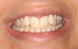 Smile Gallery - Church Road Dental and Cosmetic