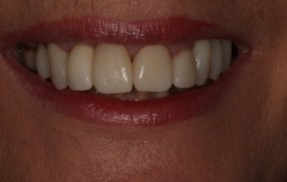 Smile Gallery - Church Road Dental and Cosmetic