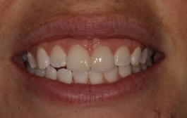 Smile Gallery - Church Road Dental and Cosmetic