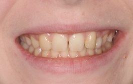Smile Gallery - Church Road Dental and Cosmetic