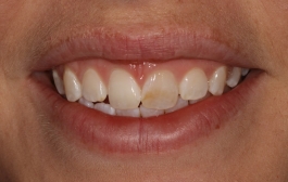 Smile Gallery - Church Road Dental and Cosmetic