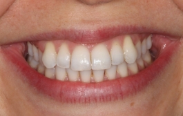 Smile Gallery - Church Road Dental and Cosmetic