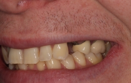 Smile Gallery - Church Road Dental and Cosmetic