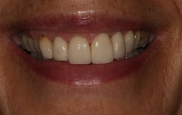 Smile Gallery - Church Road Dental and Cosmetic