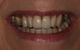 Smile Gallery - Church Road Dental and Cosmetic