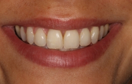 Smile Gallery - Church Road Dental and Cosmetic