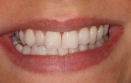 Smile Gallery - Church Road Dental and Cosmetic