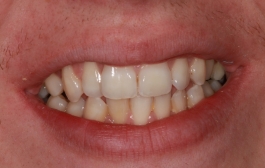 Smile Gallery - Church Road Dental and Cosmetic