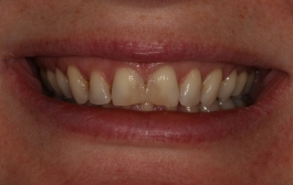 Smile Gallery - Church Road Dental and Cosmetic