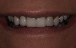Smile Gallery - Church Road Dental and Cosmetic