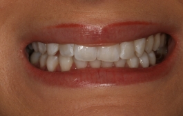Smile Gallery - Church Road Dental and Cosmetic