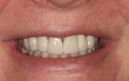 Smile Gallery - Church Road Dental and Cosmetic