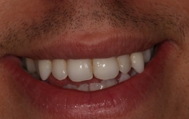 Smile Gallery - Church Road Dental and Cosmetic