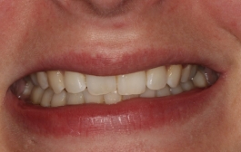 Smile Gallery - Church Road Dental and Cosmetic