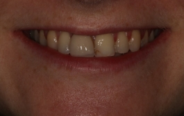 Smile Gallery - Church Road Dental and Cosmetic