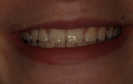 Smile Gallery - Church Road Dental and Cosmetic