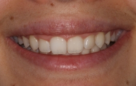Smile Gallery - Church Road Dental and Cosmetic