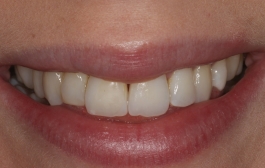 Smile Gallery - Church Road Dental and Cosmetic