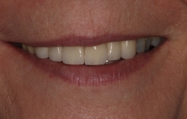 Smile Gallery - Church Road Dental and Cosmetic
