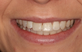 Smile Gallery - Church Road Dental and Cosmetic