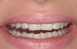 Smile Gallery - Church Road Dental and Cosmetic