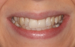 Smile Gallery - Church Road Dental and Cosmetic