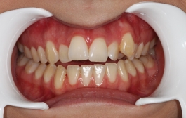 Smile Gallery - Church Road Dental and Cosmetic