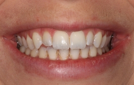 Smile Gallery - Church Road Dental and Cosmetic