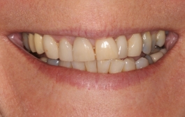 Smile Gallery - Church Road Dental and Cosmetic