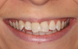 Smile Gallery - Church Road Dental and Cosmetic