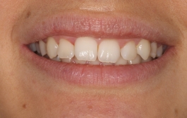Smile Gallery - Church Road Dental and Cosmetic
