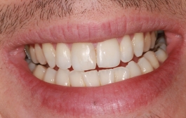 Smile Gallery - Church Road Dental and Cosmetic