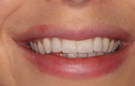 Smile Gallery - Church Road Dental and Cosmetic