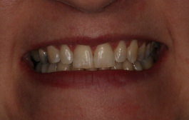 Smile Gallery - Church Road Dental and Cosmetic