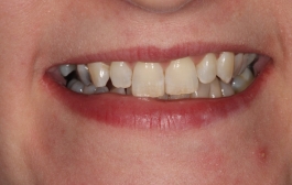 Smile Gallery - Church Road Dental and Cosmetic