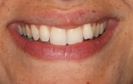 Smile Gallery - Church Road Dental and Cosmetic