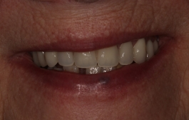 Smile Gallery - Church Road Dental and Cosmetic