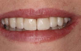 Smile Gallery - Church Road Dental and Cosmetic