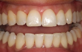 Smile Gallery - Church Road Dental and Cosmetic