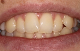 Smile Gallery - Church Road Dental and Cosmetic