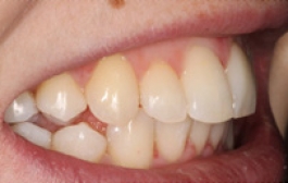 Smile Gallery - Church Road Dental and Cosmetic