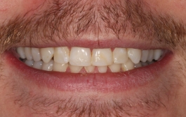 Smile Gallery - Church Road Dental and Cosmetic