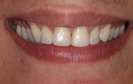 Smile Gallery - Church Road Dental and Cosmetic