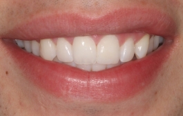 Smile Gallery - Church Road Dental and Cosmetic