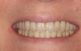 Smile Gallery - Church Road Dental and Cosmetic