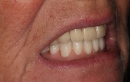 Smile Gallery - Church Road Dental and Cosmetic