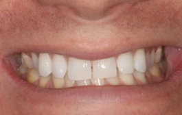 Smile Gallery - Church Road Dental and Cosmetic