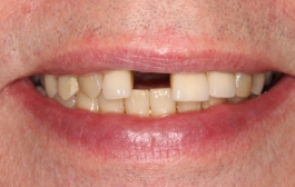 Smile Gallery - Church Road Dental and Cosmetic